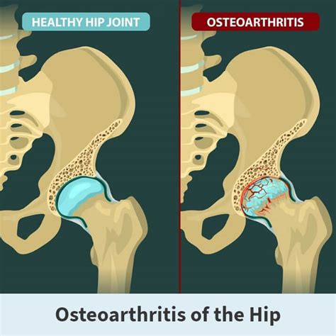 hip pain aberdeen|Osteoarthritis of the Hip .